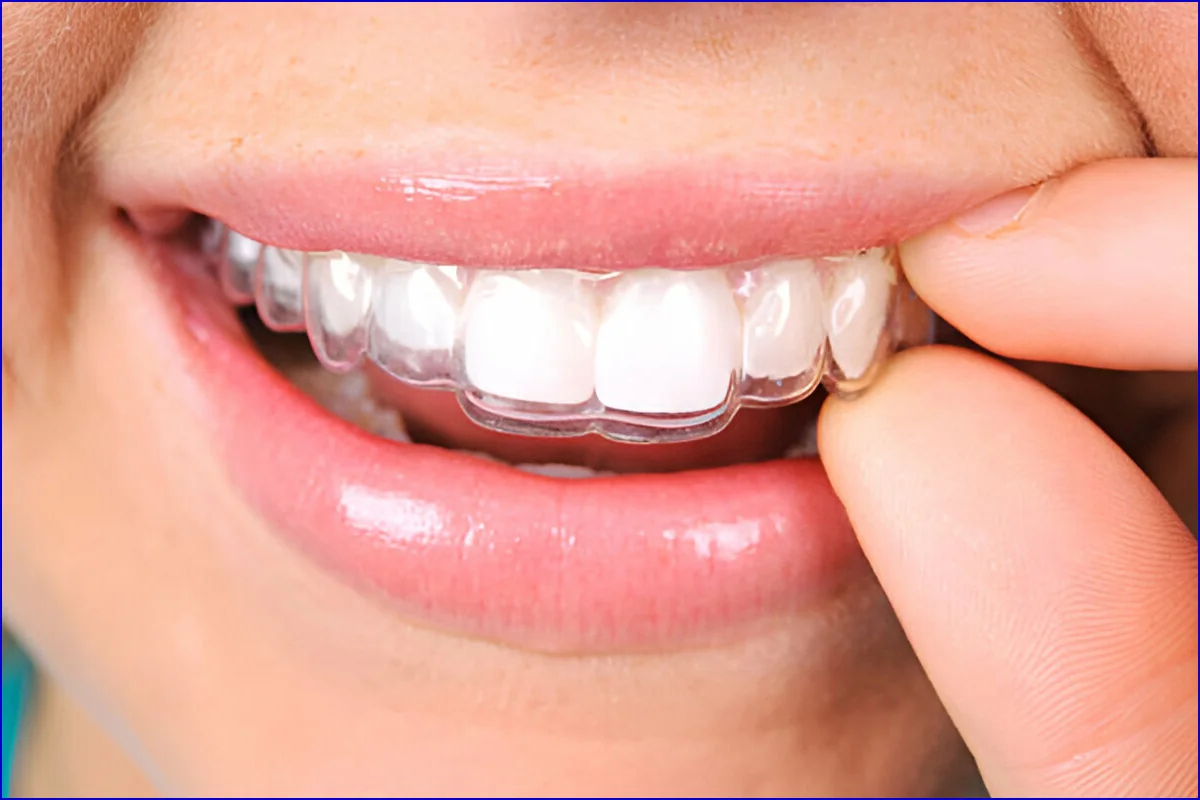 Orthodontics & Invisalign treatment visual