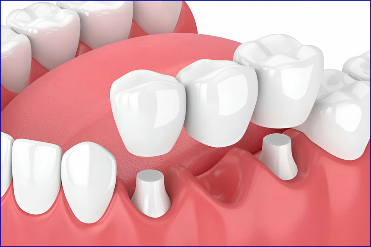 Crown & Bridge treatment photo 2
