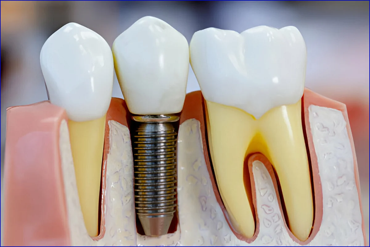 Dental Implants treatment visual