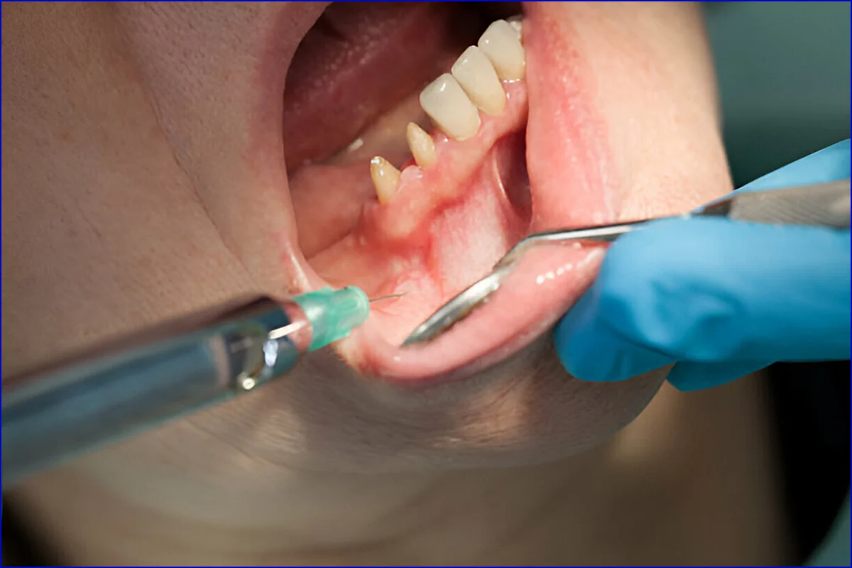 Periodontal (Gum) Surgery treatment visual