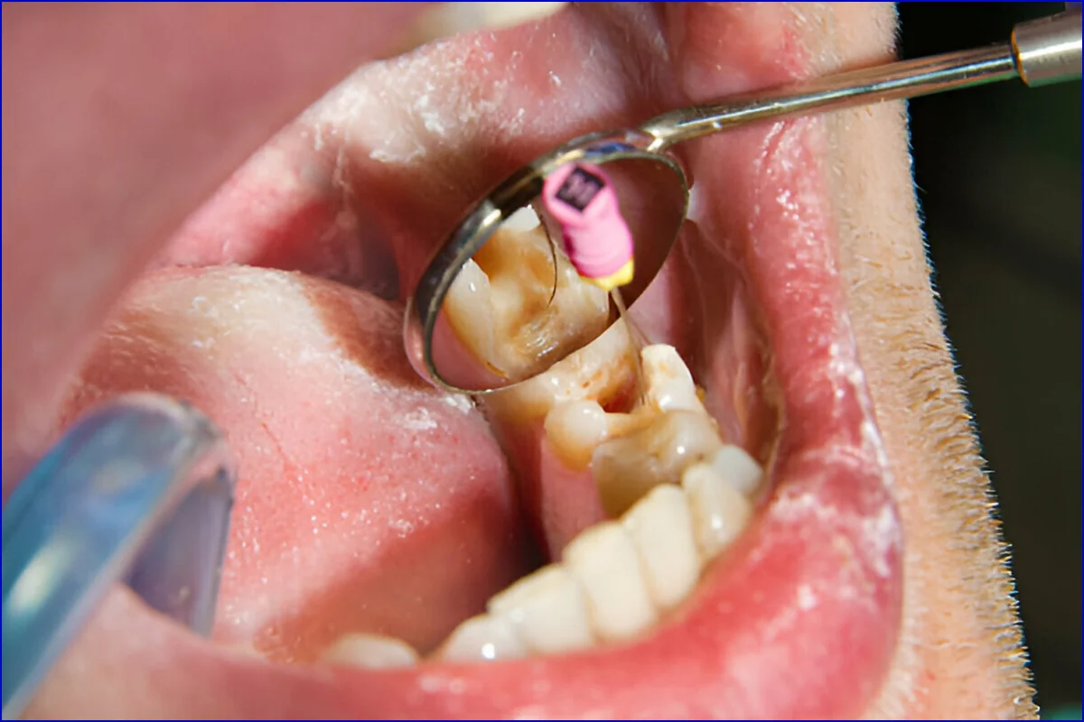 Root Canal Treatment treatment photo 2