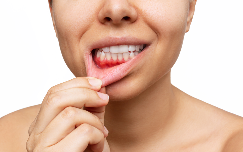 Signs of Gum Disease